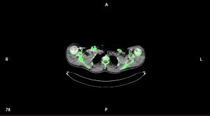 DICOM-CT-Scan-clavicle-1 | Medimodel