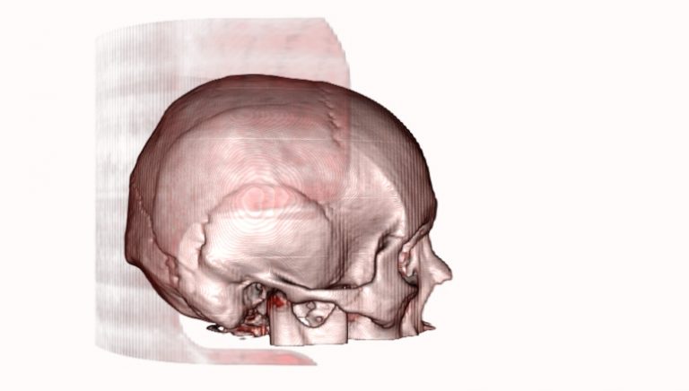 Download Human_Skull_2 Free DICOM file - Medimodel